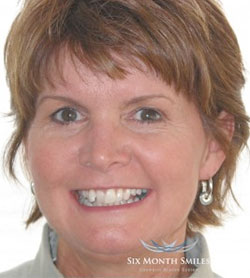Before - Six Month Smiles
