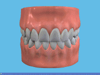 At Home Teeth Whitening